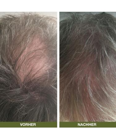 Hair Loss Rinsing Treatment for Men & Women 250ml | Tea Tree Oil & Lemon Myrtle | Soft Shiny Hair & Breakage Protection - Buy Online on GoSupps.com