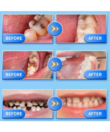 Tooth Repair Granules Kit | DIY Temporary Dental Repair for Missing & Broken Teeth | Instant Denture Prothesis & Dental Glue - Buy Online on GoSupps.com