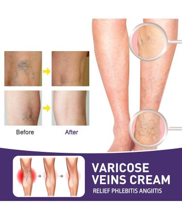 Varicose Vein Relief Cream - Promotes Blood Circulation - 20g - Buy Online on GoSupps.com