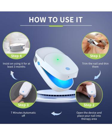 iKeener Nail Fungus Cleaning Light Device - Effective Rechargeable Solution for Discolored Thick Toenails & Fingernails - Home Use Remedy - Buy Online on GoSupps.com