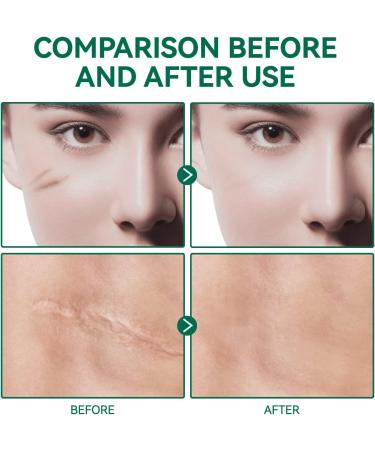 Scar Gel Cream - Advanced Treatment for Old & New Scars | Remove Scars from Face & Body - Surgical, C Section, Burn, Keloids | 50g - Buy Online on GoSupps.com
