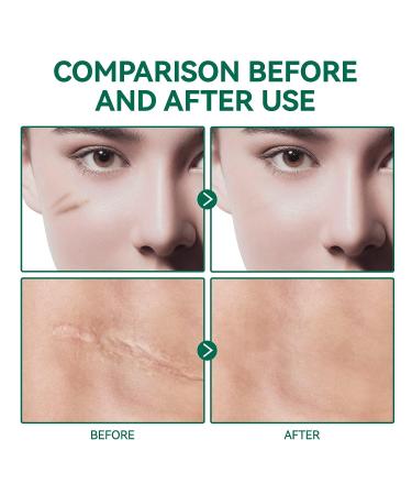 Silicone Scar Gel - Advanced Treatment for C-Section & Surgery Scars, Burns, Acne, Stretch Marks - 50ML - Buy Online on GoSupps.com