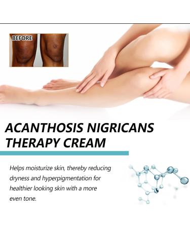 Nigrifree Acanthosis Nigricans Cream Acanthosis Nigricans Cream Lactic Acid Retinol Nigrifree Cream Brightening Face Cream Body Cream Correcting Dark Spots (50g (bottle of 2)) - Buy Online on GoSupps.com