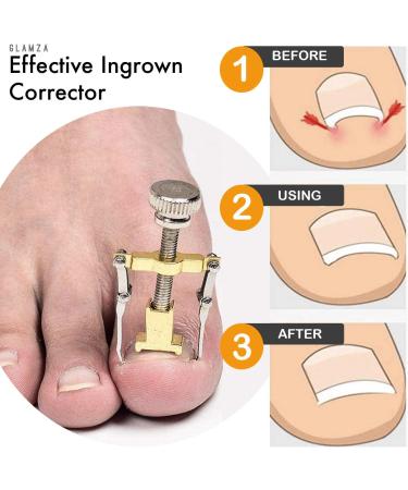 GLAMZA Ingrown Toenail Corrector Clamp - Safe & Effective Treatment Tool - Buy Online on GoSupps.com
