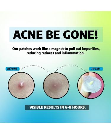 Effective Pimple Patches for Acne Treatment | Hydrocolloid Stickers for Fast Results - Shop Internationally - Buy Online on GoSupps.com