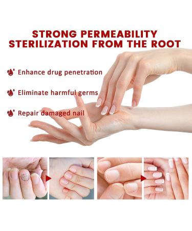 Onychomycosis Relief Oil - Rapid Toenail Repair & Ingrown Toenail Treatment (5 Sticks) - Improve Nail Health - Buy Online on GoSupps.com
