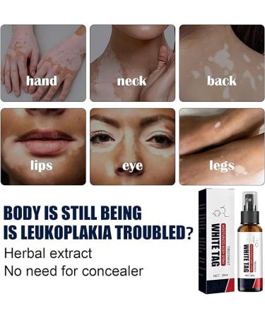 3Pcs Dermax Psoriasis Treatment Spray- Soothing Coal Tar Cream for Moisturizing Relief - Buy Online on GoSupps.com