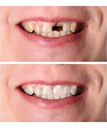 Buy Cosmetic Dentures - Temporary False Teeth Set for Men & Women | Dental Cover Top & Bottom | 2 Pairs - Buy Online on GoSupps.com