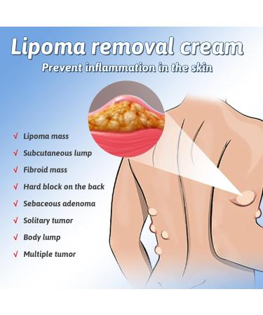 Lipoma Removal Spray Lipoma Reduction Anti-cellulite Body Shaper Spray for Men and Women 50ml - Buy Online on GoSupps.com