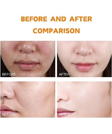 Face Exfoliator - Salicylic Acid Face Scrub - Exfoliating Face Wash for Blackhead Remover & Reduce Acne - Clean and Clear Face Wash Women - Salicylic Acid Cleanser - Hydrating Face Scrub Exfoliator - Buy Online on GoSupps.com