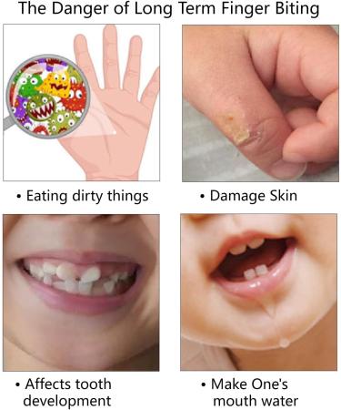 Cloverhome Thumb Sucking Stop for Kids - Color S - Buy Online on GoSupps.com