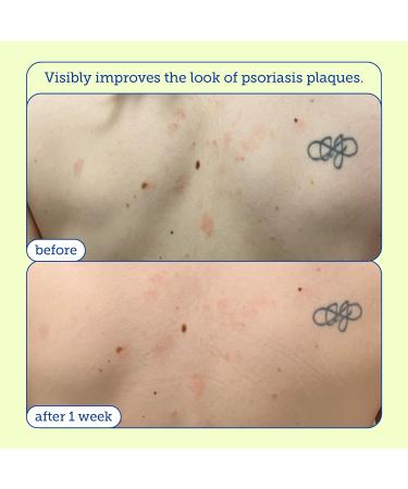 Skinfix KP+ Psoriasis Smoothing Treatment Body Lotion 5.07 oz | Soothes & Hydrates Skin - International Shipping Available - Buy Online on GoSupps.com