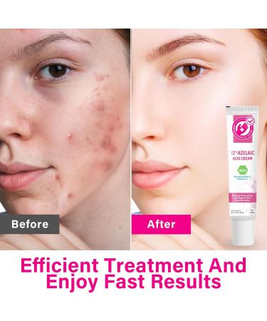 SCOBUTY Azelaic Acid Face Serum Cream Brightening Face Skin Care Treatment and Repair Dark Spots for All Skin Types 20ml 20 g (Pack of 1) - Buy Online on GoSupps.com