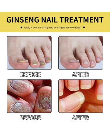 Tbeautfave Fungal Nail Treatment Nail Fungus Treatment for Toenail Ginseng Nail Treatment Essence Nail Growth Treatment Relief Oil Nail Repair Solution Toenail Oil Treatment Nail Care - Buy Online on GoSupps.com