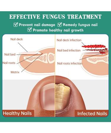 Nail Repair Cream Effective Fungal Nail Treatment for Toenails Fungus Nail Cream Nourishing For Restores Discolored & Damaged Strong Nail Fungus Treatment for Toenail Restores Healthy Appearance - Buy Online on GoSupps.com