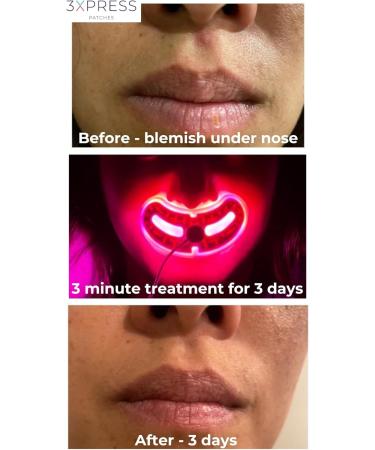LUSTRE ClearSkin 3XPRESS Beauty Patches - Bean-shaped | Targeted area for blemish prone skin | Red & Blue light therapy beauty patches for face & body - Buy Online on GoSupps.com