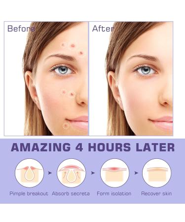 Mandabloom Acne Pimple Patches (210 Pack) with Tea Tree Oil & Salicylic Acid - Hydrocolloid Acne Dots for Face Zits & Breakouts - Buy Online on GoSupps.com