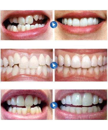 MXRFACTory Silica Gel Dentures Instant Veneers Removable Snap on Cosmetic Temporary Jagged Smile Upper Bottom Whitening Repair Kit Men and Women 5pairs - Buy Online on GoSupps.com