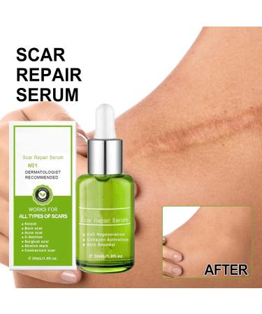 Goopgen Advanced Scar Repair Serum - Effective Scar Removal Spray for All Types of Scars - Buy Online on GoSupps.com