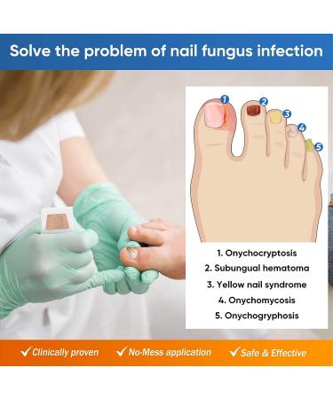 32Pcs Nail Repair Patches - Toenail Fungus Treatment for Damaged Nails - Buy Online on GoSupps.com