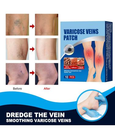 10PC Varicose Veins Patch | Effective Treatment for Varicose & Spider Veins | Enhance Circulation | Fast International Shipping - Buy Online on GoSupps.com