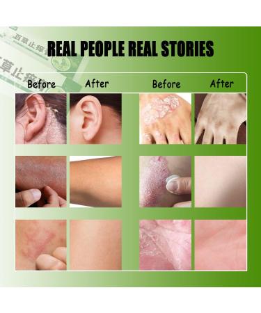 Natural Herbal Eczema and Psoriasis Cream for Sensitive Skin - Moisturizing Treatment for Dermatitis, Shingles, Acne, Rosacea - Anti-Itch Relief for Dry Skin (0.71oz, Pack of 6) - Buy Online on GoSupps.com