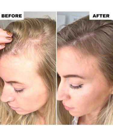 Aumude Scalphero - Smart Waterproof Scalp Massager for Hair Growth | Portable Electrics for Men & Women - Buy Online on GoSupps.com