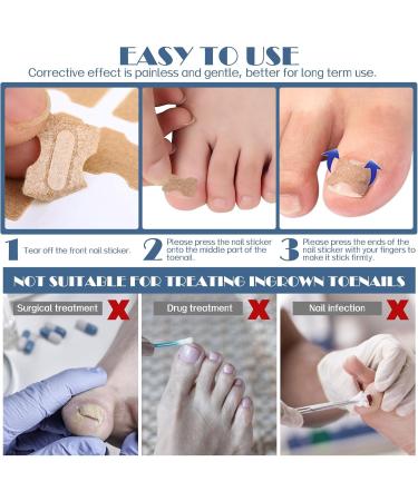 Ingrown Toenail Corrector Patch 300PCs Ingrown Toenail Corrector Strips Toenail Correction Patches Ingrown Toenail Treatment Tool Foot Care No-Glue Painless Toenail Correction Stickers - Buy Online on GoSupps.com