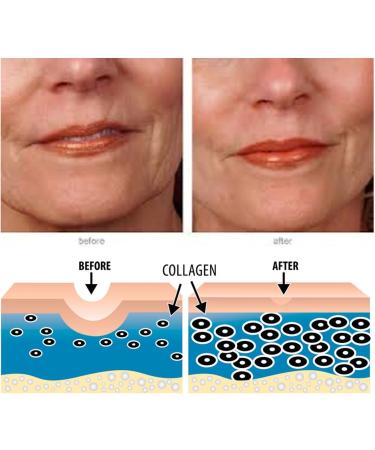 Infinitive Beauty Professional Derma Stamp - Titanium Microneedle (0.2mm to 3.0mm) for Optimal Skin Care - Buy Online on GoSupps.com