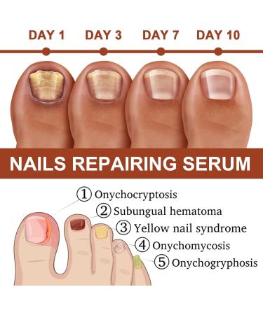 GFOUK 7 days Nail Growth and Strengthening Serum for Thin Nails Nail Growth and Strength Serum Nail Cuticle Oil Strengthener Stronger Nails in 1 Week Nail Strengthening Treatment (2 pcs) - Buy Online on GoSupps.com