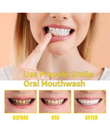 Propolis Smile Mouthwash - Natural Tartar Removal Tooth Whitening & Bad Breath Elimination (2 Pieces) - Buy Online on GoSupps.com