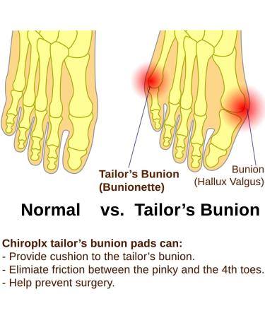 Chiroplax Tailor's Bunion Corrector Pad - Bunionette Straightener Separator Spacer (6 Pack) - Buy Online on GoSupps.com