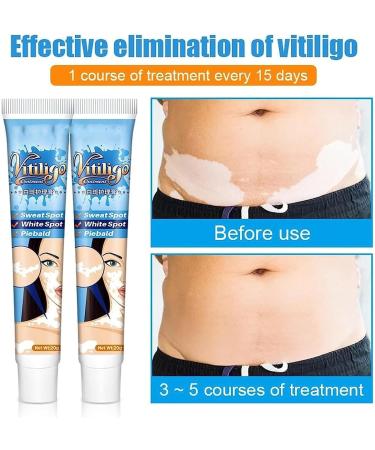 EXQST Vitiligo Therapy Cream - Reduce White Spots, Improve Skin Pigmentation - 5 Pcs - Buy Online on GoSupps.com