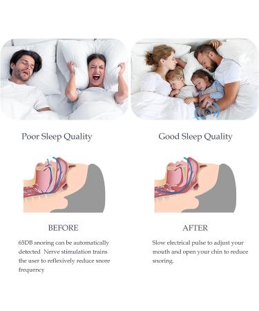 Smart Snore Stopper Sleep Connection Wristband - Effective Anti-Snoring Solution for Men and Women - Buy Online on GoSupps.com