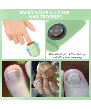 Ikeen Nail Fungus Treatment Device - Effective Onychomycosis Solution with Red & Blue Light Therapy | Painless & Fast Nail Health Improvement - Buy Online on GoSupps.com