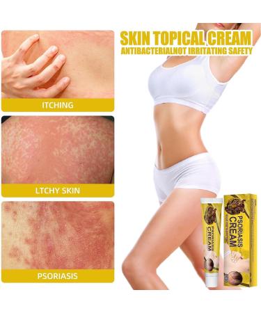 Doxenem Eczema & Psoriasis Cream - Control Reoccurrence, Tinea Versicolor Treatment, Dark Spots Relief for Adults - Buy Online on GoSupps.com