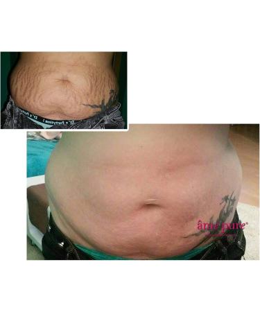 Ame Pure Microneedling Roller - Micro Needling Roller For Stretch Marks Scars And Cellulite! - Durable Derma Roller 0.75 mm - Laser Treatment Alternative - Glow & Thrive: Revitalize Your Skin Today! - Buy Online on GoSupps.com