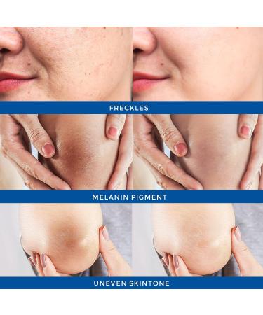 Le phoqua Dark Spot Corrector Cream - Age, Melasma, Sun Spot, Hyperpigmentation Treatment - Buy Online on GoSupps.com
