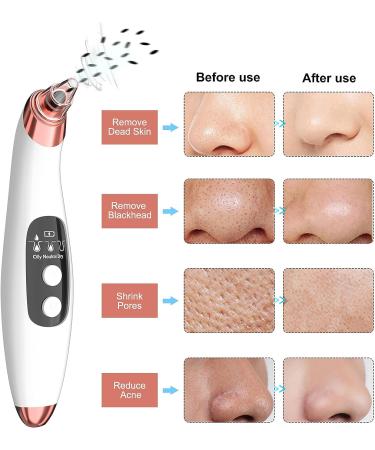 2022 Upgraded Blackhead Remover Pore Vacuum Kit | Facial Pore Cleaner Electric Acne Extractor Tool with 6 Probes | USB Rechargeable | For Women & Men | Suitable for Oil, Dry, and Mixed Skin - Buy Online on GoSupps.com