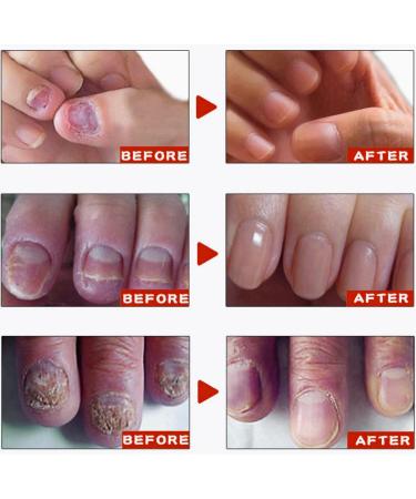 Fungal Nail Treatment Cream Antifungal Nail Polish Cream Nail Fungus Treatment for Toenail Strong Anti-Fungal Toenail Cream Nail Improve Cream Nail Repair Cream for Thick Cracked Discolored Nails - Buy Online on GoSupps.com