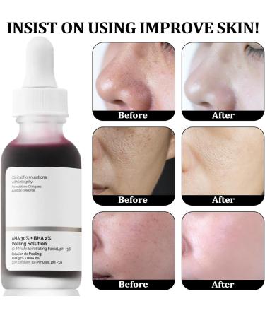 AHA 30% + BHA2% Peeling Solution Exfoliating Facial Serum for Hydrated Serum for Face Peeling Solution Reduces Pore Congestion and Fine Lines Smooth Skin Skincare Tightening Cream for Face - Buy Online on GoSupps.com