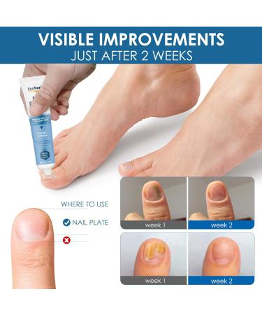 Extra Strength Toenail Fungus Treatment Cream for Thick, Broken, Discolored Nails - 1 Count - Buy Online on GoSupps.com