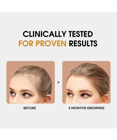 Buy Women s Balance Hair Growth Supplements - Proven Formula for Thicker Hair & Scalp Coverage | Dermatologist Recommended (120 Capsules) - International Shipping Available - Buy Online on GoSupps.com