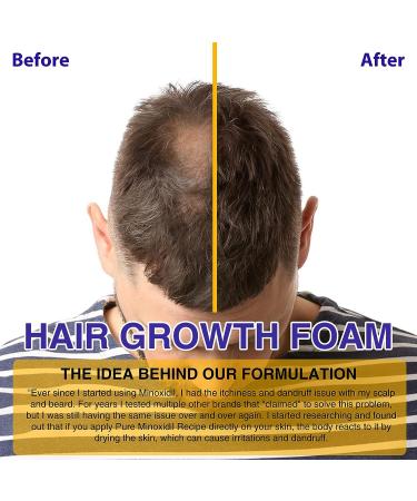 Minoxidil 5% Foam for Men and Women | Biotin Hair Regrowth Treatment | Stop Thinning and Hair Loss | 1 Month Supply - Buy Online on GoSupps.com