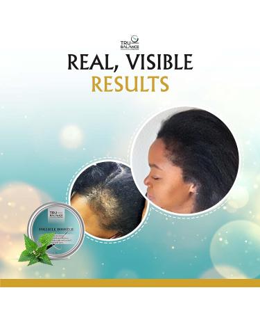 TRU BALANCE Follicle Booster Hair Growth Balm - Natural Scalp Nourishment for Hair Regrowth - DHT Blocker for Men & Women - Buy Online on GoSupps.com