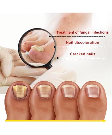 Anti-Fungal Nail Treatment Kit with Nail Clippers & Glass Nail File - Natural Ingrown Toenail Correction & Fungal Nail Repair - 2 in 1 Nail Care Solution - Buy Online on GoSupps.com