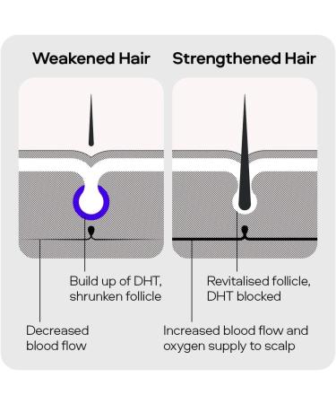 Sons Complete Hair Loss Treatment - Minoxidil 5%, Biotin & DHT Blocking Shampoo - Men's Hair Growth Solution - Promotes Regrowth - 1 Month Supply - Buy Online on GoSupps.com