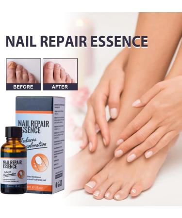 Nail Repair Oil Toe Nail Fungal Treatment Nail Fungus Treatment for Endophyt Nail Anti fungus Nail Repair and Strengthen Fix & Renew Damaged Broken Nails - Buy Online on GoSupps.com