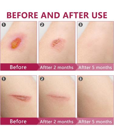 Manuka Honey Gauze Dressing 2x2 | Medical Grade Honey Patches for Wound Care | Pack of 10 for Faster Healing - Buy Online on GoSupps.com