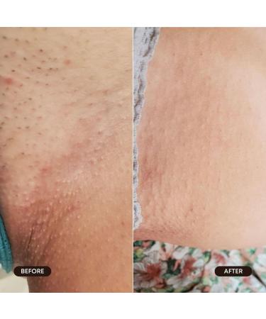Bushbalm Roller Rescue Ingrown Hair Serum | Exfoliating AHA & BHA for Razor Bumps Soothing Cooling for Intimate Areas & Underarms - 50ml - Buy Online on GoSupps.com